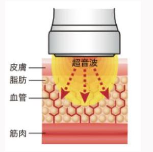 キャビエスト CAVIEST キャビテーション+ラジオ波 複合痩身機器