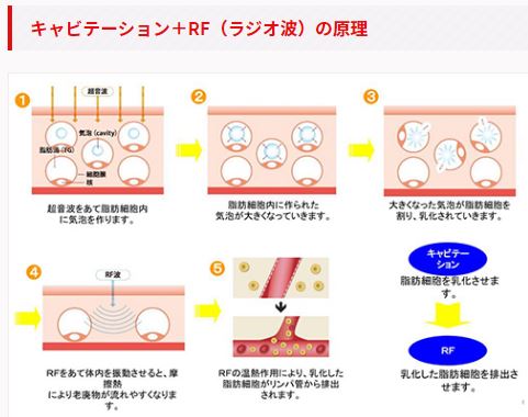 キャビエスト　CaviEst  業務用　キャビテーション\u0026ラジオ波RF 痩身機器