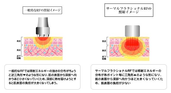 DIA-GA ディアーガ ハイフ＋サーマルフラクショナル　美容機器