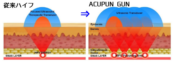 ACUPUN GUN