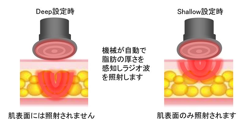 ビービー２（BE-BEⅡ）5機能 トータルケアマシン キャビテーション HI-RF 吸引