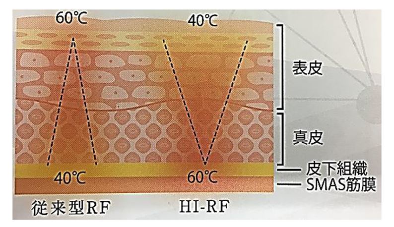 ビービー２（BE-BEⅡ）5機能 トータルケアマシン キャビテーション HI-RF 吸引