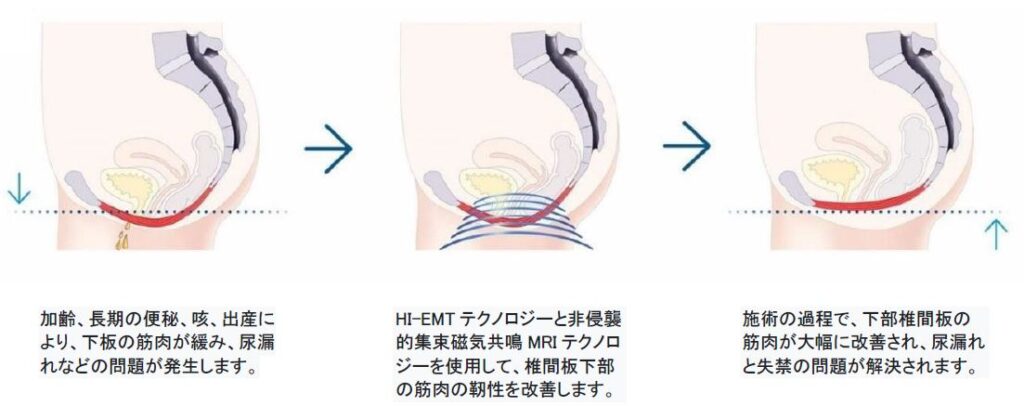 電磁パルス痩身電磁パルスHI-EMT骨盤底筋トレ一ニングチェア 等しく