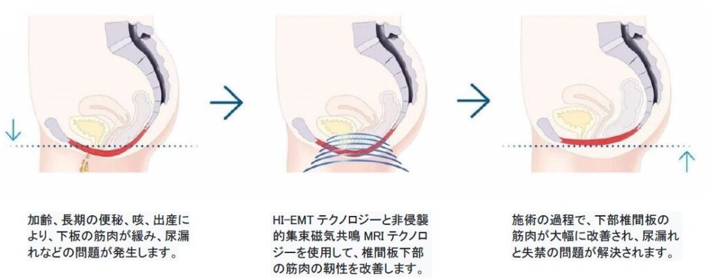 電磁パルス Muscle MagFit Ⅲ（マッスルマジックフィット）ボディ痩身機