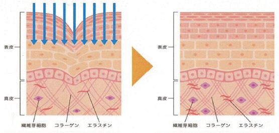 水光注射 ニードルレスインジェクター RE LUSTER （リ レスター） 美容機器 フェイシャル